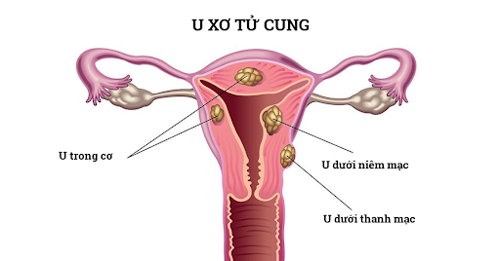 Rong kinh do u xơ tử cung - chữa thế nào?